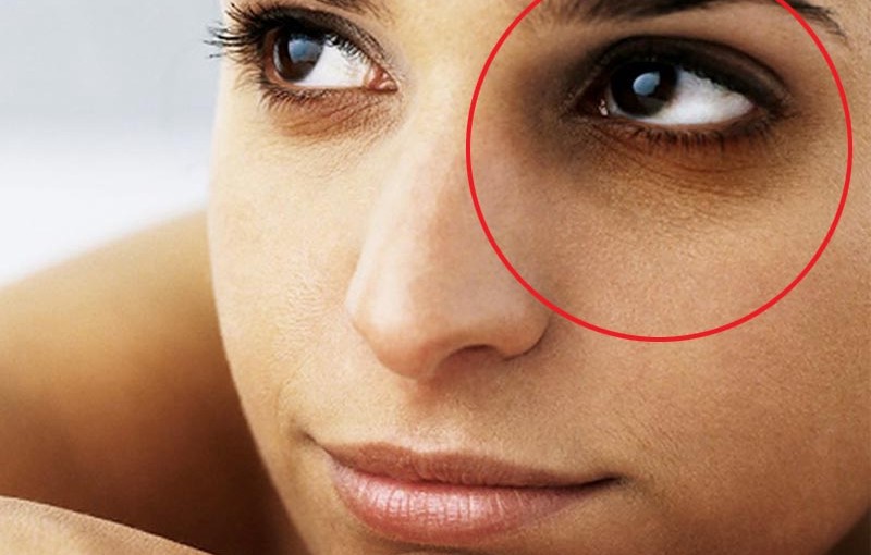 How to get rid of dark circles