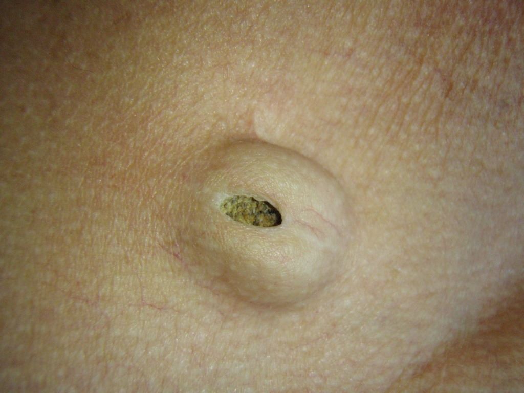Epidermoid Cysts of the Skin